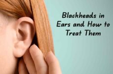 Blackheads in Ears