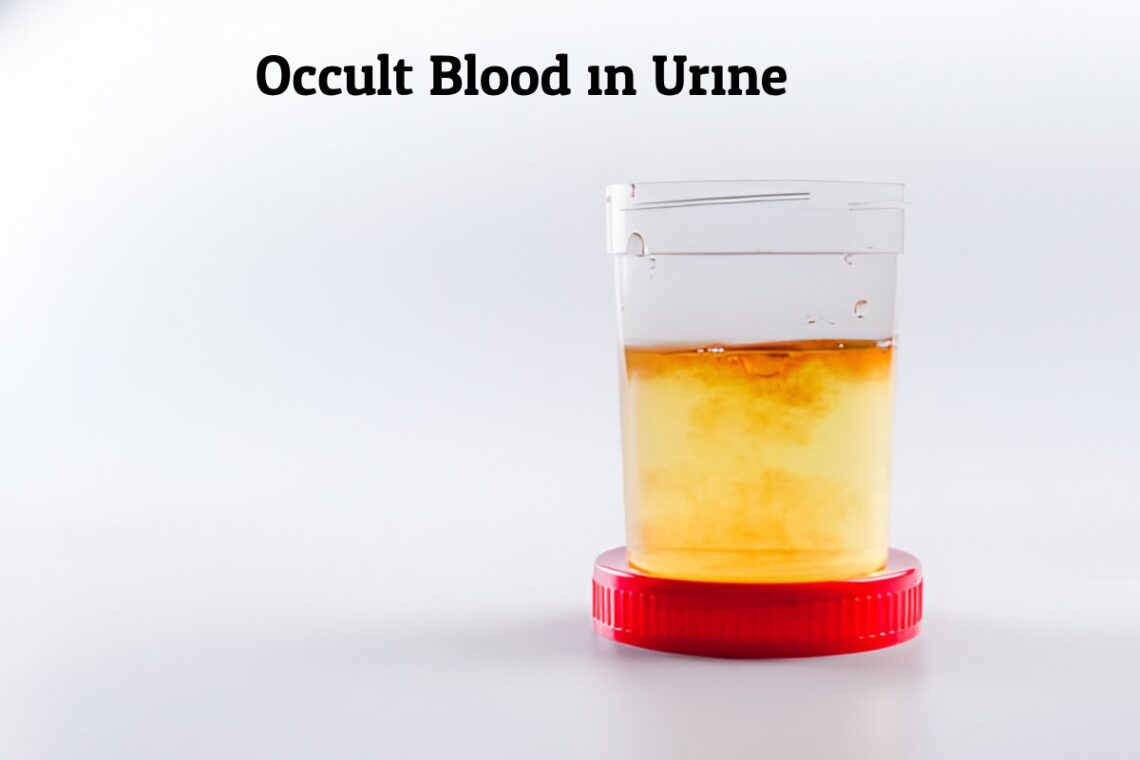 Occult Blood in Urine